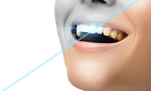 Types of Teeth Whitening Procedures​