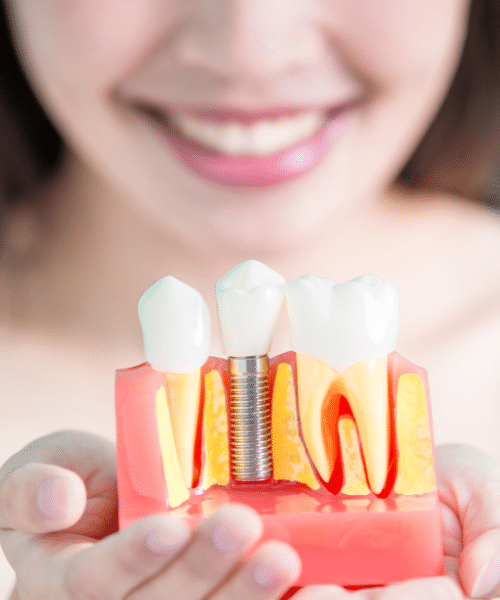 Best Dental Implants in Worth, IL