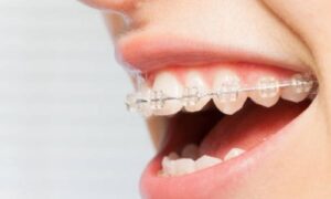 This article will explore the concept of Invisalign pressure, what it means, and how to manage it effectively.