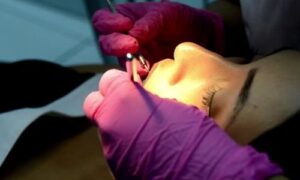 Tooth Cupping Treatment